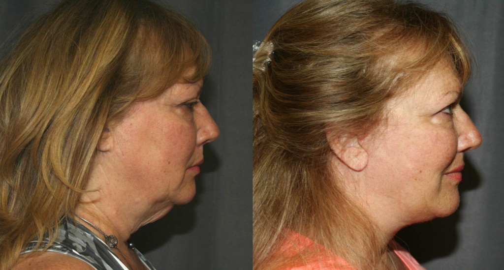 Before and After Neck Lift as seen from the side. Loose skin under the chin is removed and the angle between the neck and chin is improved. Facelifts also improve jowls, clean-up the jawline and reduce the loose skin that accumulates around the mouth and sides of the nose as we age.