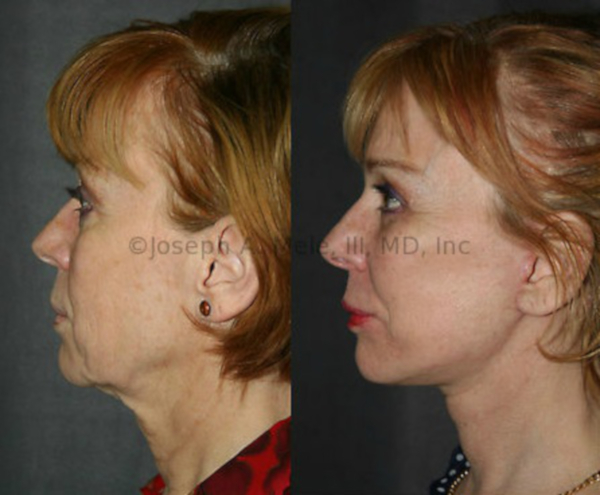 Facelift with Cheek Implants