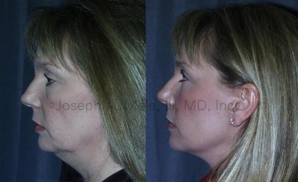 Facelifts are more common performed after age 50, to reverse the sequela of aging: jowls, deep naso-labial folds and sagging neck skin.