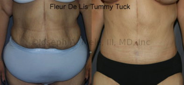 The Fleur-de-Lis Tummy Tuck is an unusual Tummy Tuck that includes not only the usual low abdominal skin resection, but also removes skin from the middle of the abdominal wall to tighten side to side.