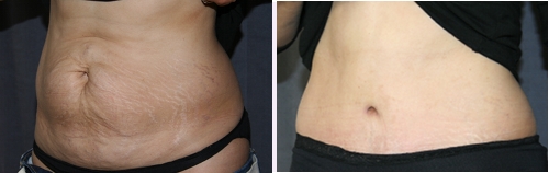 Full Tummy Tuck (Abdominoplasty) of the Abdomen - Before (Left) / After (Right)