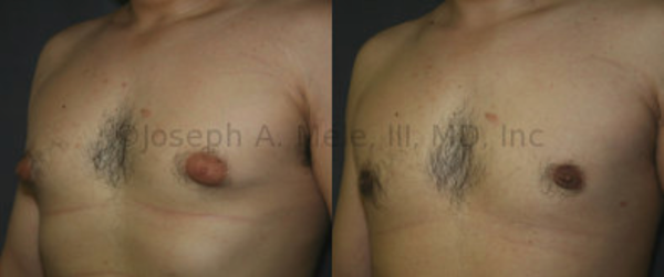 Gynecomastia Reduction: In this case, direct excision of the glandular tissue from under the areola not only smooths the chest's contour, but also reduces the apparent size of the areolae -- the pigmented skin that surrounds the nipple. The darker color is simply a result of the same amount of pigment distributed over the new, significantly smaller, area.