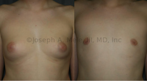 Gynecomastia Reduction: Sometimes the amount of breast tissue on the chest is enough to completely feminize the chest. Liposuction, combined with direct excision of the glandular components, restored the flat chest that this young man is expected to have. Again, the reduction in areolae is due to the skin's elastic contraction after the breasts are unstuffed.
