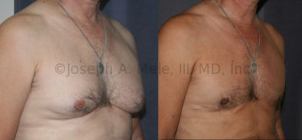 Gynecomastia Reduction: Sometimes the skin enveloping the breasts is redundant. This man has breast enlargement and sagging from his gynecomastia and loose skin. In this case, the breast tissue and the excess skin were removed through an incision that runs along the bottom of each breast. Without this, the skin would sag further over the inframammary fold from the loss of support caused by removing the chest's stuffing, just like deflating a balloon causes the  balloon to fall over.