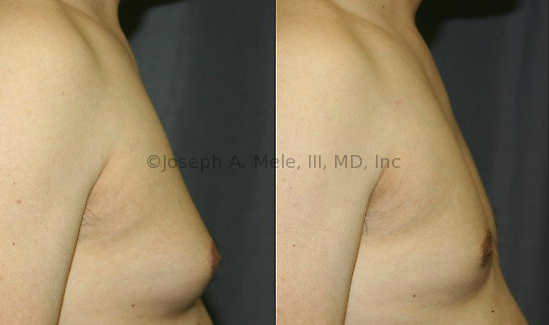 Adult Gynecomastia is unlikely to resolve on its own. Male Breast Reduction Surgery can help restore normal proportions and enhance the masculine chest.