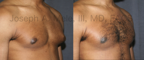 Gynecomastia Reduction for male breast enlargement before and after pictures