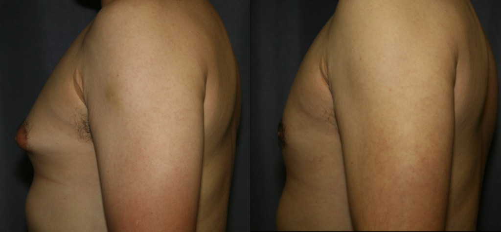 Gynecomastia Before and After Pictures - Firm breast tissue fills the areola and pushes the nipple out causing embarrassment in and out of clothing. Reduction with a combination of Liposuction and precise excision of the tough glandular tissue provides a smooth and more attractive result.