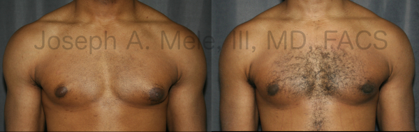 Before and after pictures of Gynecomastia Reduction for male breast enlargement.