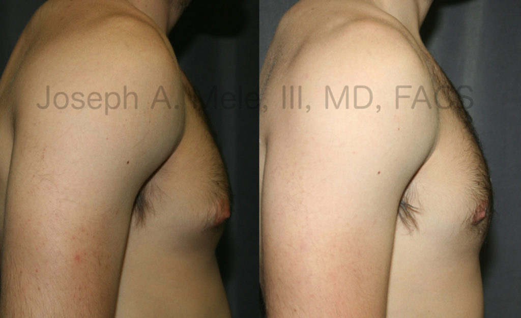 Male Breast Reduction is one of the most requested cosmetic plastic surgery procedures year after year.