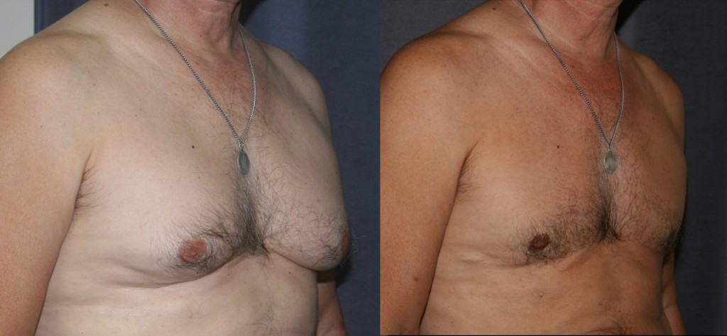 Gynecomastia and Skin Reduction - The before picture shows enlarged breasts with disproportionate fat, excess glandular tissue and skin folding onto itself at the base of the breasts. After, the excess fat, gland and skin have been removed through an incision that runs along the base of the breasts. As his tan shows, after breast reduction, this patient is happier both in and out of clothing.