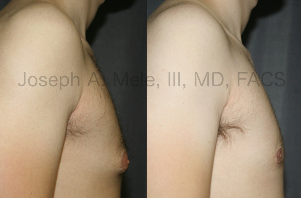 Gynecomastia Reduction for Tubular Breasts before and after photos.