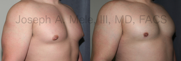 Gynecomastia Reduction for Body Builders before and after photos