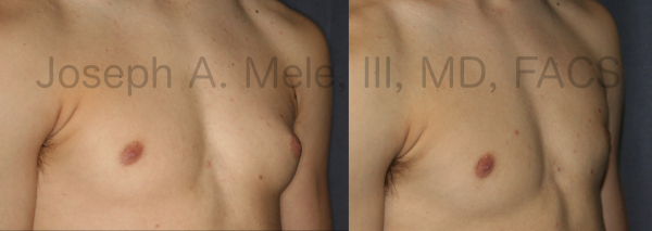 Before and after photos of Gynecomastia Reduction for the asymmetrical male chest.