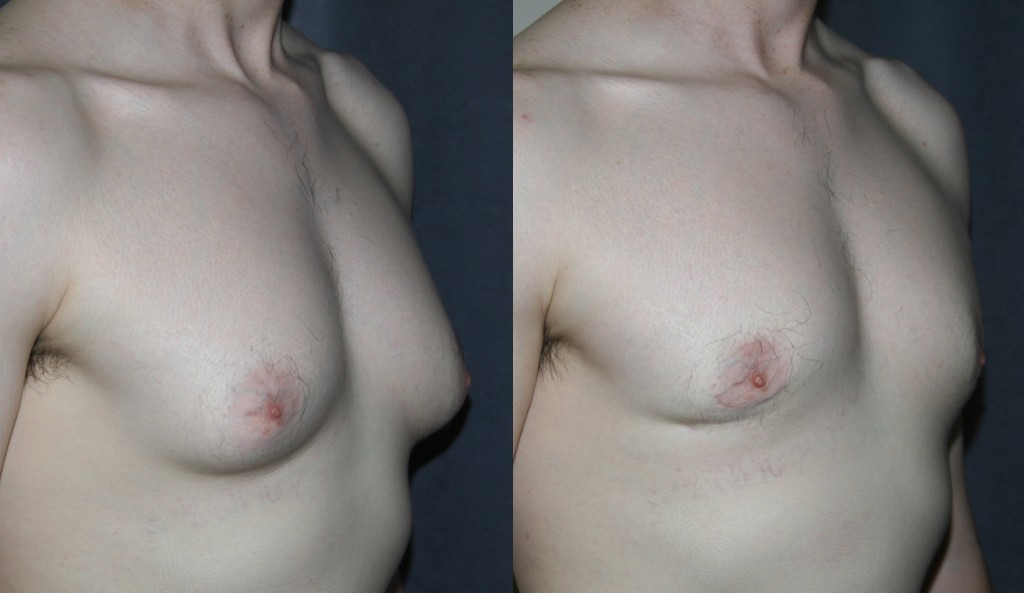 <strong>Gynecomastia</strong> is Male Breast Enlargement, and not in a good way. The problem can occur at any age, but is most common during puberty, and in one-third of cases, lasts a lifetime. Gynecomastia Reduction can help masculinize the chest again.