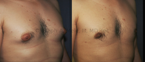 Breast buds can lead to "puffy nipples," really the enlargement of the areolae rather than the nipple proper. Gynecomastia reduction surgery can remove the disproportionate breast tissue and masculinize the chest.