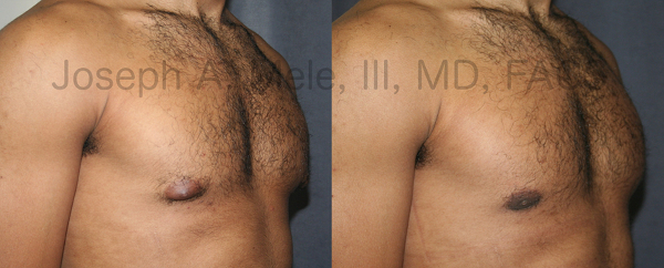 Gynecomastia may involve just the area beneath the nipple and areolae or the entire chest. In the male breast reduction before and after pictures above, the fullness beneath the nipples was removed through a small incision placed along the lower margin of the areolae.