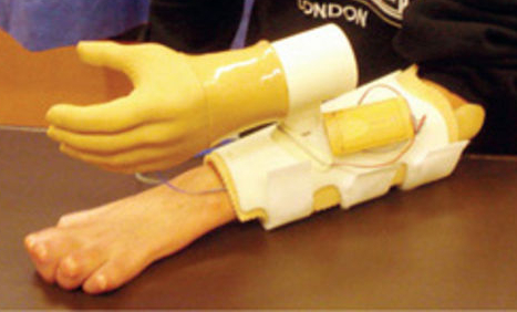 Bionic Hand Training: Marcus's forearm is attached to sensors that pick-up the commands his brain is sending to the transplanted nerves in the forearm. A computer interprets these and translates them into motion of the prosthesis.