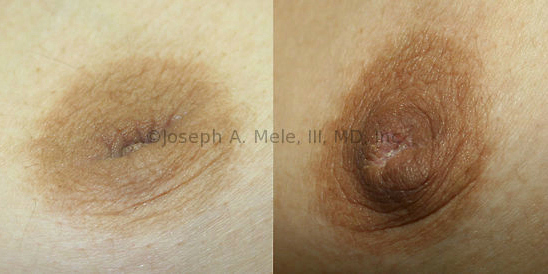 If you have an inverted nipple, and want to know what can be done, give us a call at (925) 943-6353.