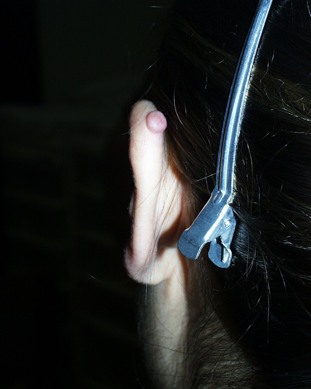 Keloid of the ear - view from behind.