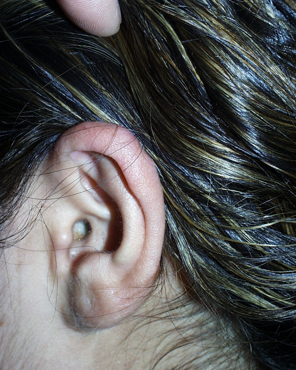 Side view of ear after resection of keloid.