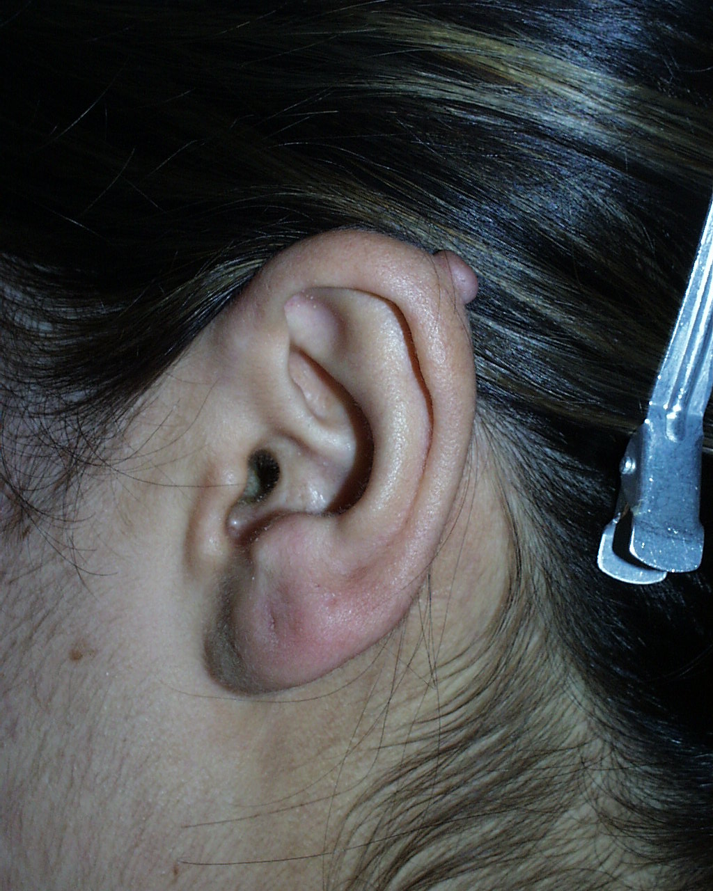 Keloid scar at 1 o'clock the helix of the ear.