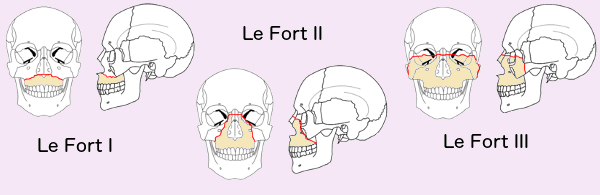 Rene Le Fort documented how the face breaks with severe trauma. In Le Fort I fractures, the upper jaw is separated from the face. With Le Fort II fractures, the nose and upper jaw are separated from the face. A Le Fort III fracture is the separation of all the facial bones from the skull. All Le Fort fractures are worth avoiding, and are less likely, if you wear your seat belt.