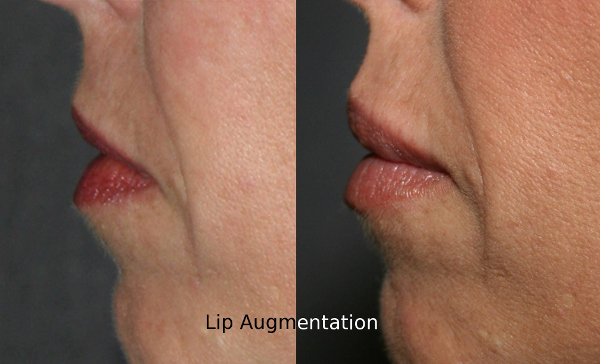 Lip Augmentation Before and After Photos