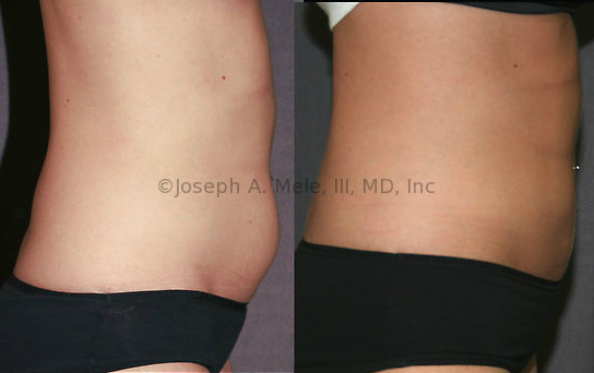 Liposuction removes disproportionate fat and allows the skin to recoil with minimal scars.