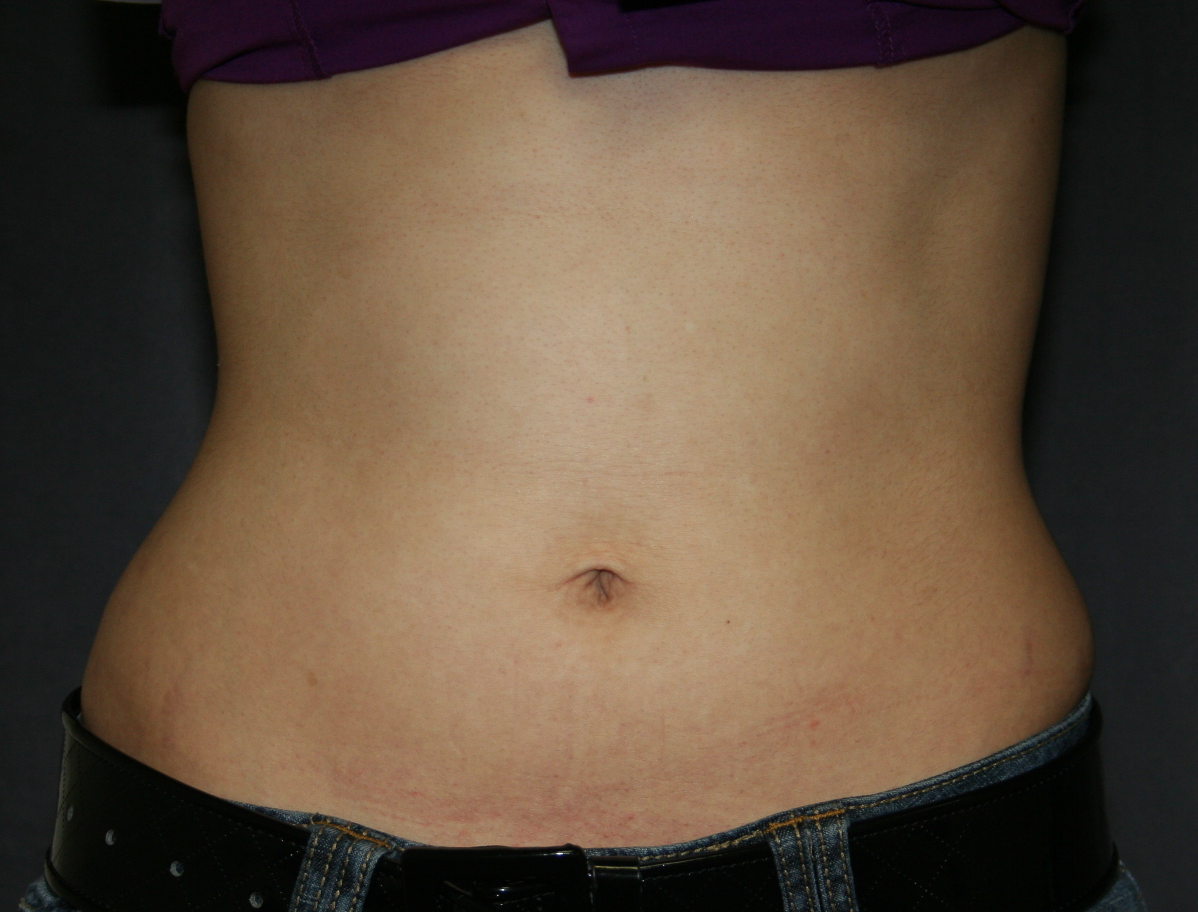 Abdomen after simple tumescent liposuction - front view