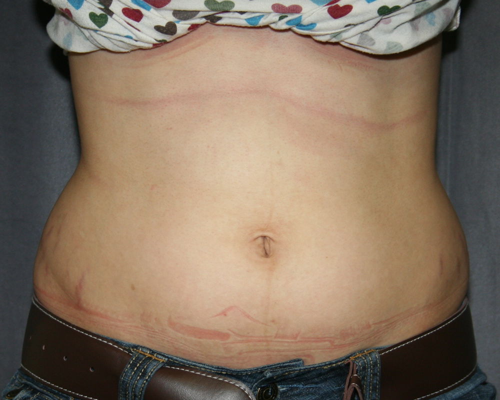 Abdomen before simple tumescent liposuction - front view