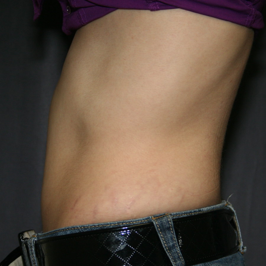 Abdomen after simple tumescent liposuction - side view