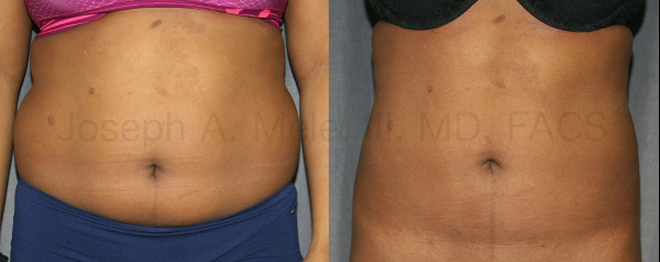 Liposuction removes disproportionate fat through very small incisions that can be placed away from the contouring. When the skin is tight, liposuction is an excellent way to reduce belly bulge and muffin tops.