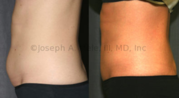 Liposuction of the Abdomen