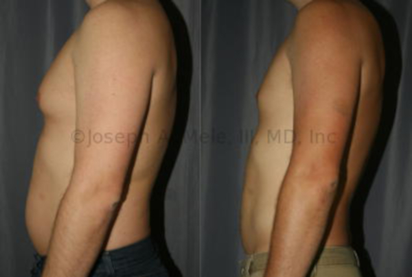 Liposuction of the Chest and Abdomen in a Man