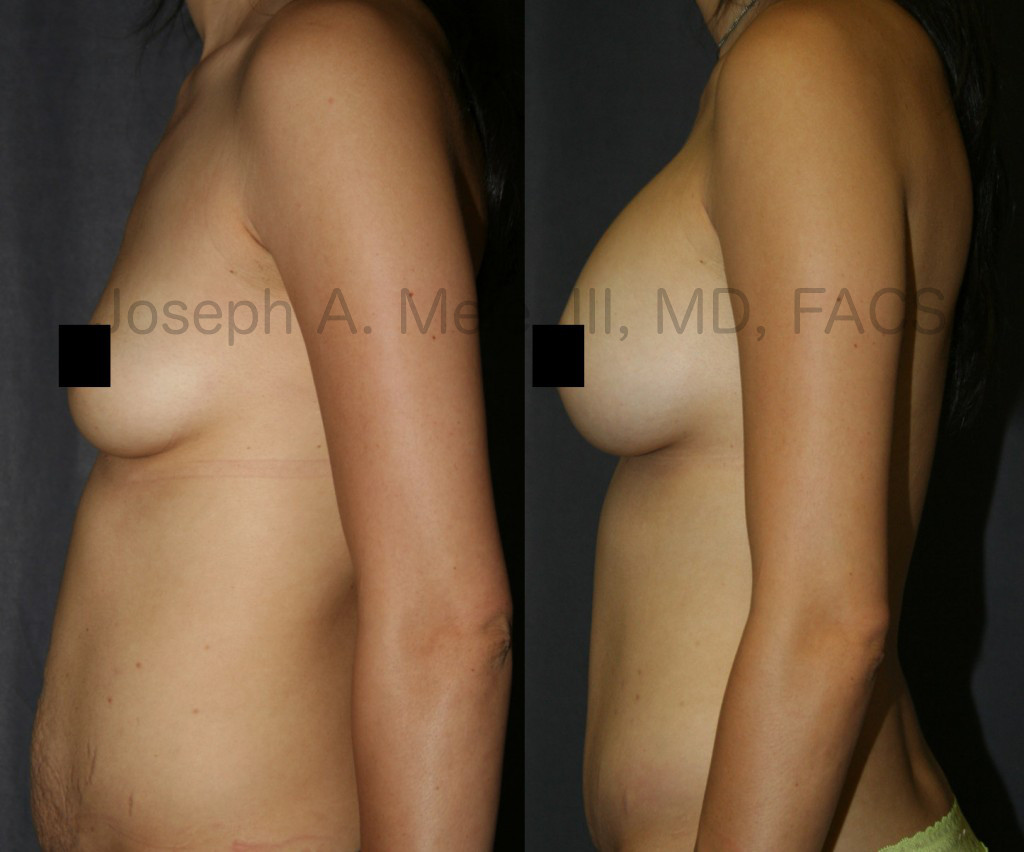 The Mommy Makeover above is a combination of Breast Augmentation with Breast Implants and a Tummy Tuck (Abdominoplasty). Not all Mommy Makeovers include Breast Augmentation or even Abdominoplasty. Other options are illustrated below.