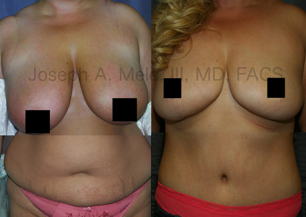 Mommy Makeovers can also include the combination of Breast Reduction and Tummy Tuck with Liposuction. The procedures are often performed together; however, they can be staged. Above, the results of the Breast Reduction and Tummy Tuck with Liposuction are combined.