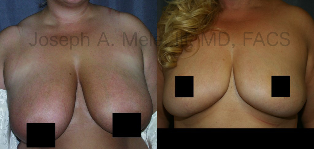 Some Mommy Makeovers include a Breast Reduction rather than Breast Augmentation.