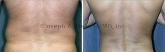 Men can get muffin tops too. Here, the disproportionate bulge above the belt-line was quickly removed with liposuction.