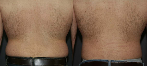 Male Muffin Top Removal - Liposuction of the Body