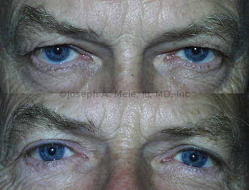 The Male Eyelid Lift (Male Blepharoplasty) above was performed to improve sight. Upper and lateral (outer) gaze was blocked by overhanging skin. The Blepharoplasty lifted the eyelids without distorting the eyebrows. Bags beneath the eyes were also reduced. Comparing the upper before and lower after pictures, he looks less angry and tired and more friendly and rested.