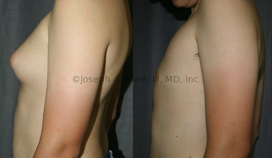 Adolescent Gynecomastia - A common time for presentation, and correction is at adolescence.