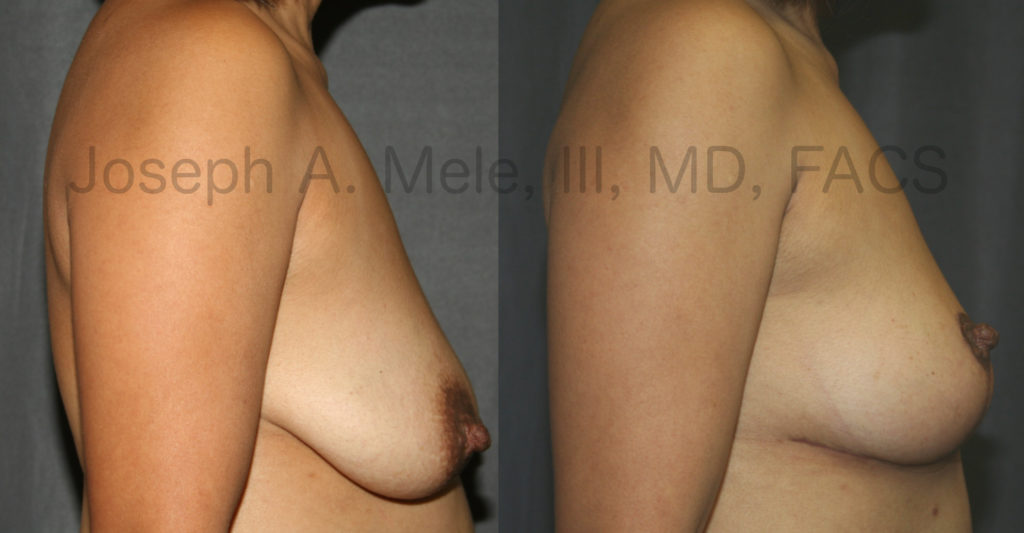 It is easy to see the improvements that this Breast Lift achieved in the uncensored Mastopexy before and after photos above. Breast Augmentation was not performed, so the breast volume has not changed; however, the overall breast aesthetic has improved dramatically. An inverted-T Breast Lift was performed to improve the breast shape and nipple position. The areolae were also reduced with an Areolar Reduction. The result is much more youthful breasts.