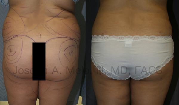 There are two main ingredients for a successful Brazilian Buttocks Lift - selective removal of fat from areas that are too full and selective placement of fat into the buttocks.