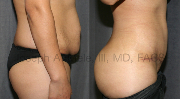 A Brazilian Butt Lift was added to this Mommy Makeover. Excess fat from the belly and muffin top was removed and transplanted into the buttocks, to enhance both the size and shape of the buttocks.