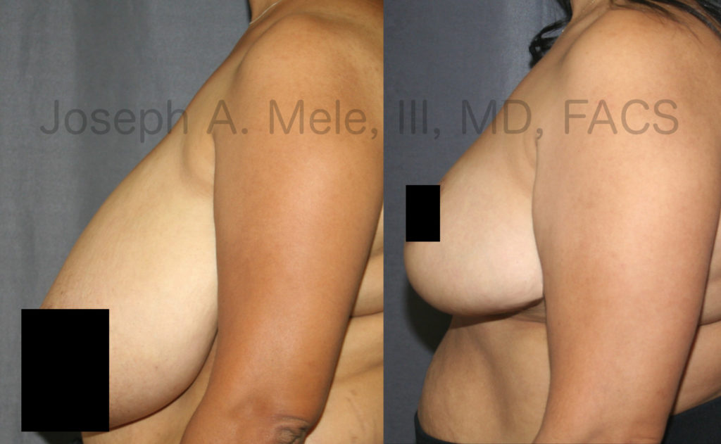 Breast Reduction can significantly reduce neck, back and shoulder pain.