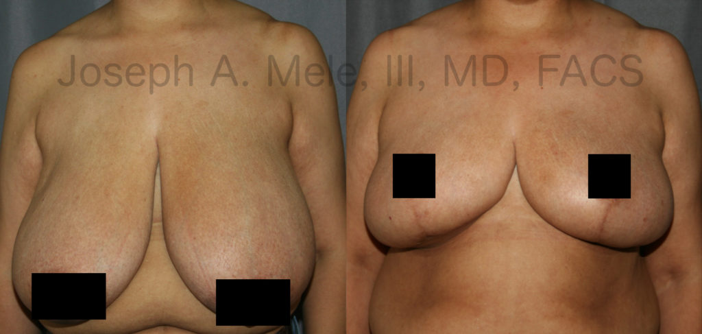 <strong>Reduction Mammoplasty Before and After Pictures:</strong> Breast Reduction not only helps reduce the symptoms associated with large breasts but can also increase ones fashion options.
