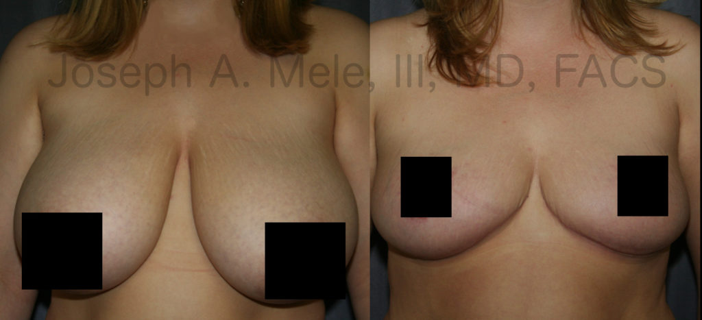 Breast Reduction combines reduction of the breast volume with a breast lift to reduce the torque on the back an  the neck.