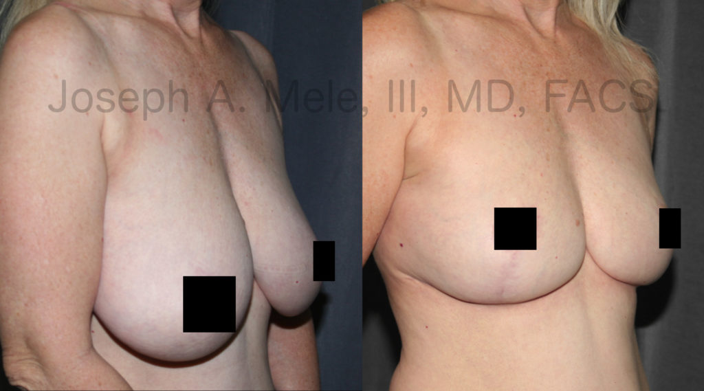 These Breast Reduction before and after pictures demonstrate the amount of reduction and enormous lift possible with the inverted T-technique. You will notice that the breast hangs well below the level of the mole visible anterior to the crook of her elbow in the before photo, while in the after photo, the base of the breast is well above it.