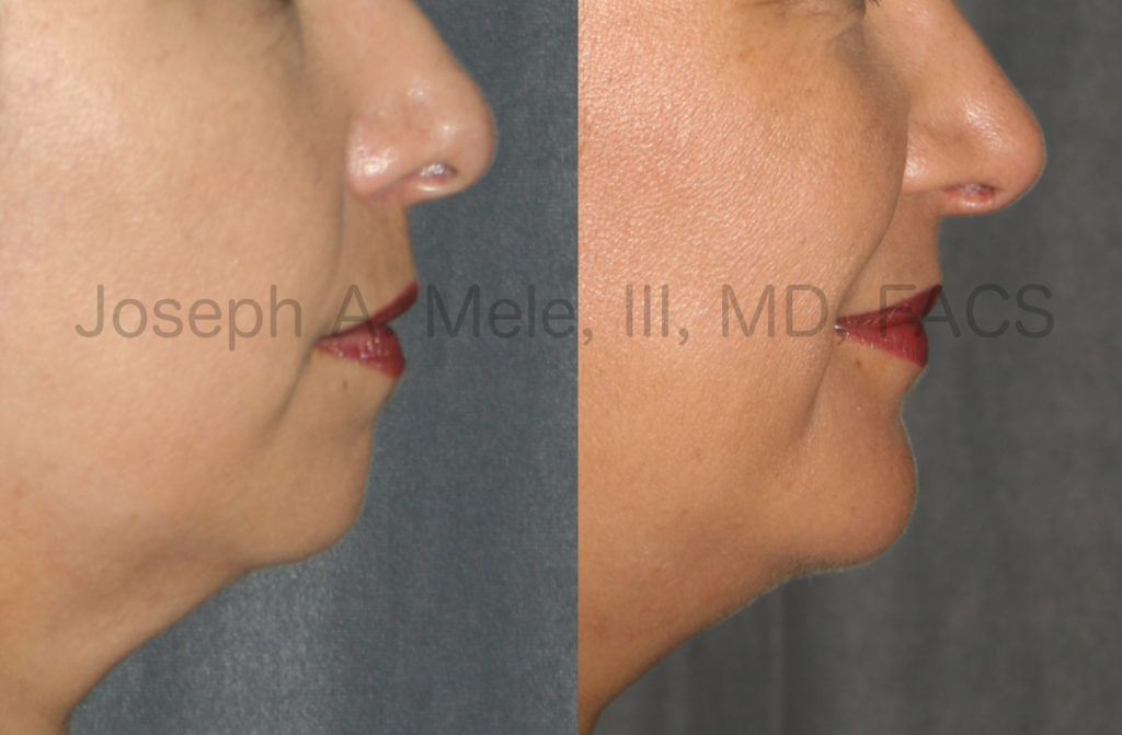 Chin Augmentation before and after pictures: Chin Implants can increase chin projection and definition. Before Chin Augmentation, her chin appears flat, is poorly defined and allows the lip and neck to blend into each other. After Chin Augmentation, the Chin Implant provides a defined chin, which clearly separates the lip from the neck. Additionally, the chin's projection now matches the lips' and balances the lower face.