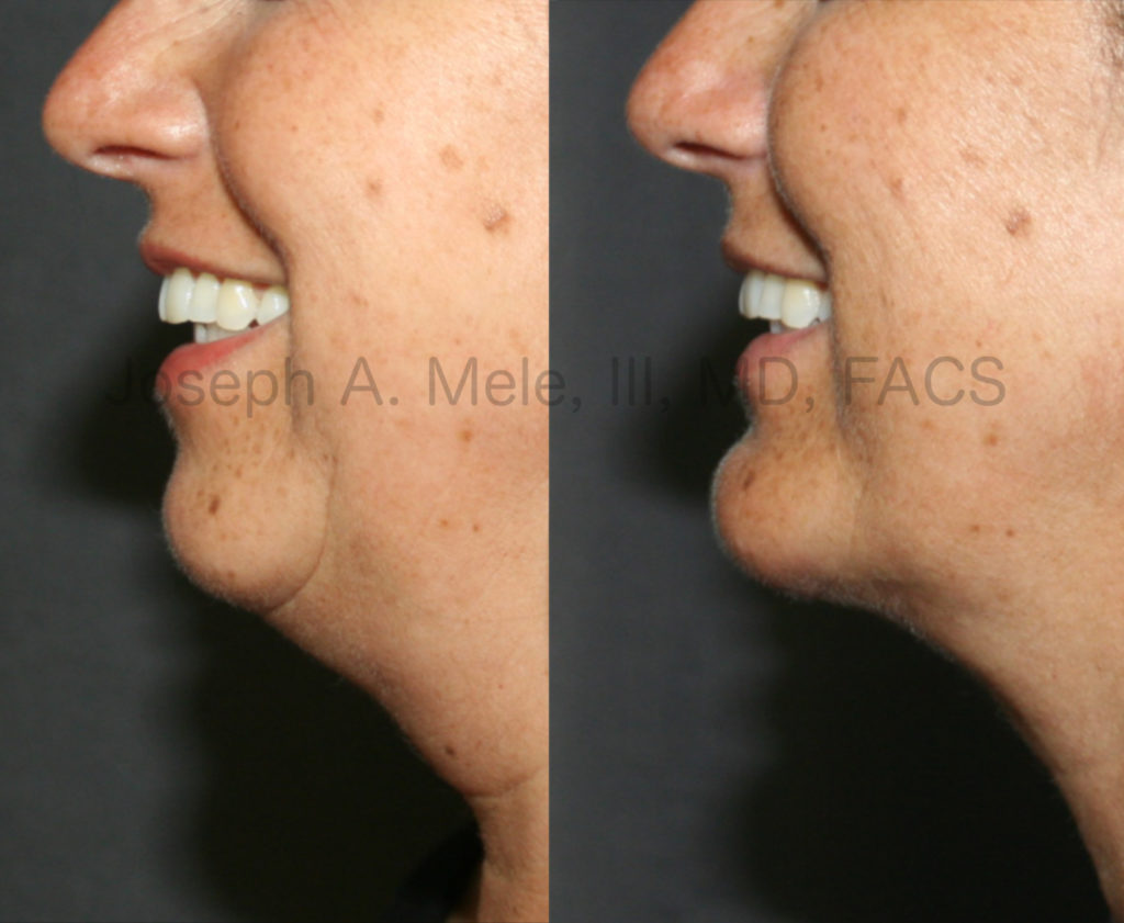 Chin Implants provide stable Chin Augmentation. In the above Chin Implant before and after pictures the patient is smiling. Even with animation, the enhanced projection is maintained and the definition of the neck line is clearly defined. In cases where there is disproportionate fat of the neck, Chin Augmentation can be combined with Neck Liposuction to further enhance your profile. 